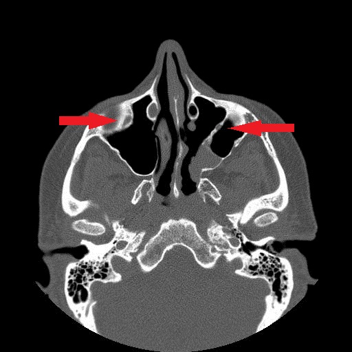 File:Bilateral Ectopic Infraorbital Nerves (Radiopaedia 49006-58325 Axial 5).jpg