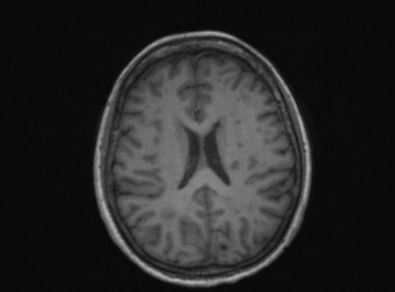 Bilateral PCA territory infarction - different ages (Radiopaedia 46200-51784 Axial T1 207).jpg