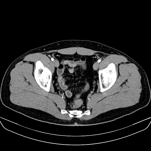 Bilateral accessory renal arteries with mild pelvi-ureteric junction (PUJ) obstruction (Radiopaedia 66357-75596 A 65).jpg