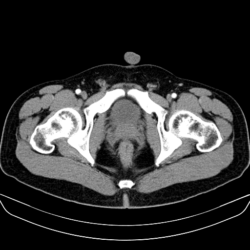 Bilateral accessory renal arteries with mild pelvi-ureteric junction (PUJ) obstruction (Radiopaedia 66357-75596 A 74).jpg