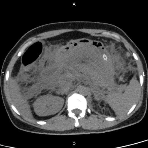 Bilateral adrenal gland hyperenhancement in pancreatitis (Radiopaedia 86642-102753 Axial non-contrast 37).jpg