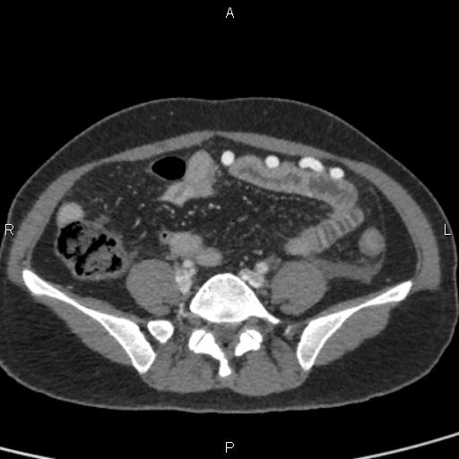 Bilateral adrenal gland hyperenhancement in pancreatitis (Radiopaedia 86642-102753 E 79).jpg