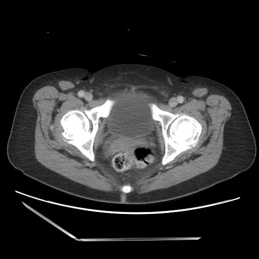 File:Bilateral adrenal granulocytic sarcomas (chloromas) (Radiopaedia 78375-91007 Axial 90).jpg