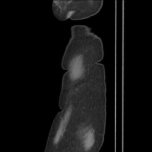 Bilateral adrenal granulocytic sarcomas (chloromas) (Radiopaedia 78375-91007 C 17).jpg