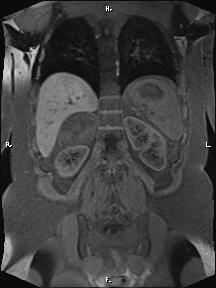 File:Bilateral adrenal myelolipoma (Radiopaedia 63058-71537 Coronal T1 fat sat 32).jpg