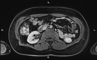File:Bilateral adrenal myelolipoma (Radiopaedia 63058-71537 H 54).jpg