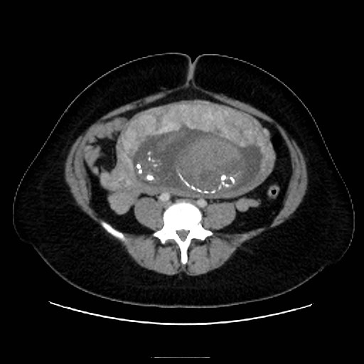 Bilateral adrenal thrombosis (Radiopaedia 58182-65256 A 50).jpg
