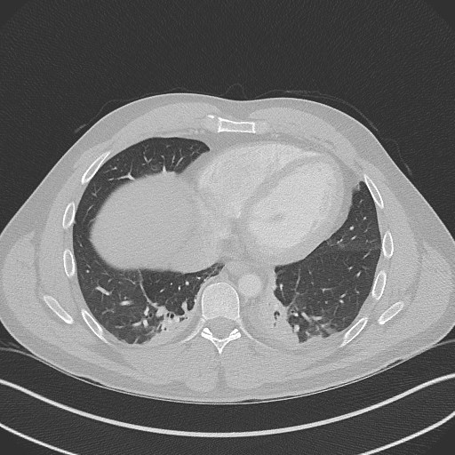 Bilateral atelectasis (Radiopaedia 48666-53675 Axial lung window 80).jpg