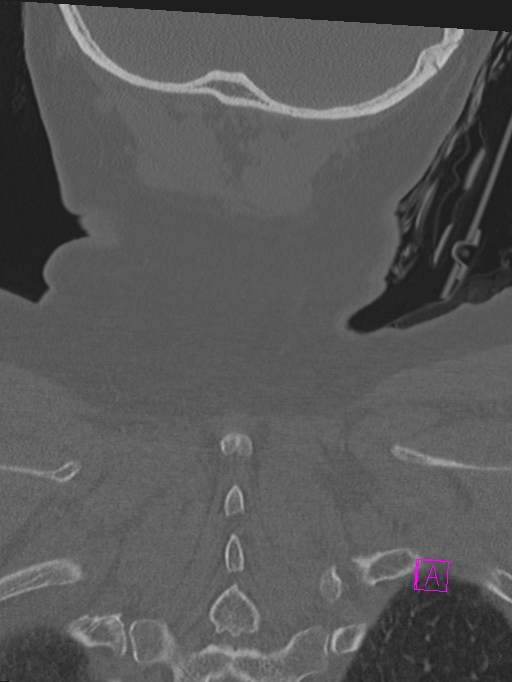 Bilateral atlanto-occipital assimilation (Radiopaedia 28350-28603 Coronal bone window 49).jpg