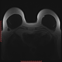 File:Bilateral breast implant rupture (Radiopaedia 24761-25027 PASTA 20).jpg