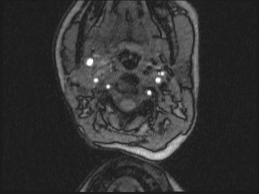 Bilateral carotid body tumors and right glomus jugulare tumor (Radiopaedia 20024-20060 Axial MRA 268).jpg