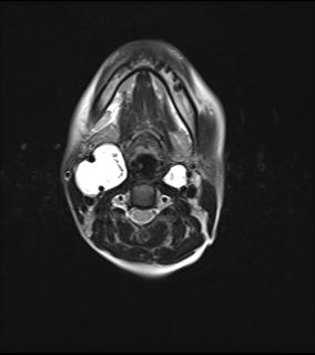 File:Bilateral carotid body tumors and right jugular paraganglioma (Radiopaedia 20024-20060 Axial 41).jpg