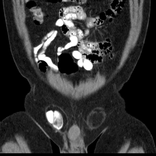File:Bilateral direct inguinal herniae (Radiopaedia 17016-16719 A 5).jpg