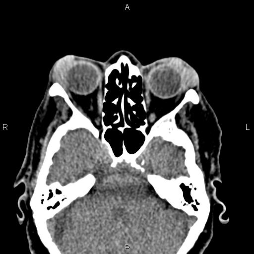 Bilateral enlargement of lacrimal glands - sarcoidosis (Radiopaedia 62627-70921 Axial non-contrast 41).jpg