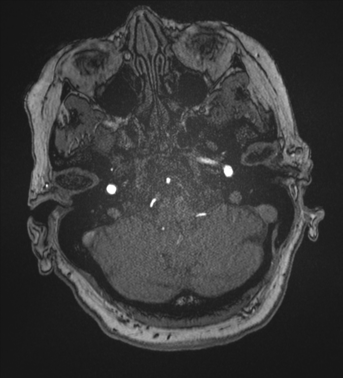 Bilateral fetal posterior communicating arteries (Radiopaedia 41286-44102 Axial MRA 25).png