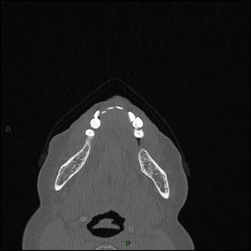 File:Bilateral frontal mucoceles (Radiopaedia 82352-96454 Axial bone window 303).jpg