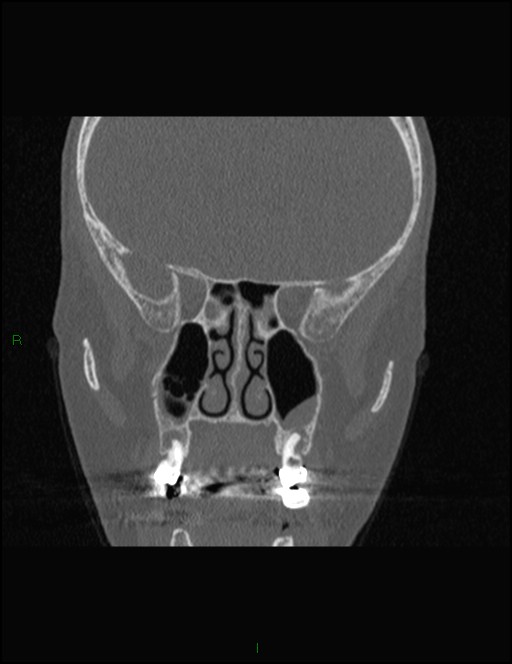 Bilateral frontal mucoceles (Radiopaedia 82352-96454 Coronal 175).jpg