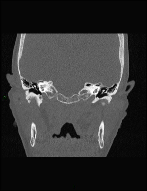 Bilateral frontal mucoceles (Radiopaedia 82352-96454 Coronal 297).jpg
