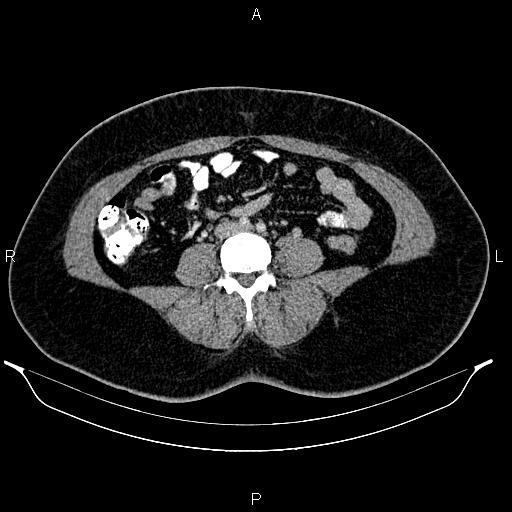 File:Bilateral ovarian dermoid cysts (Radiopaedia 85785-101603 A 65).jpg