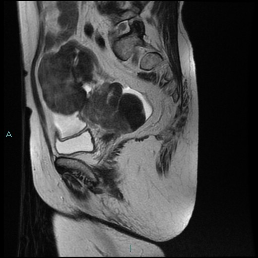File:Bilateral ovarian fibroma (Radiopaedia 44568-48293 Sagittal T2 13).jpg