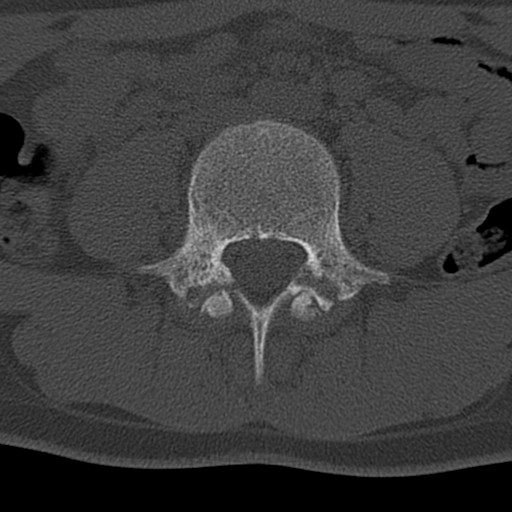 Bilateral pars defect (Radiopaedia 26691-26846 Axial bone window 26).jpg
