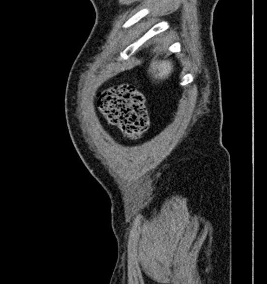 Bilateral rectus sheath hematomas (Radiopaedia 50778-56252 B 8).jpg