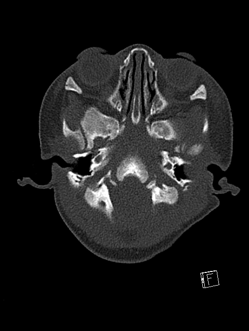Bilateral subdural hemorrhage and parietal skull fracture (Radiopaedia 26058-26192 Axial bone window 115).png