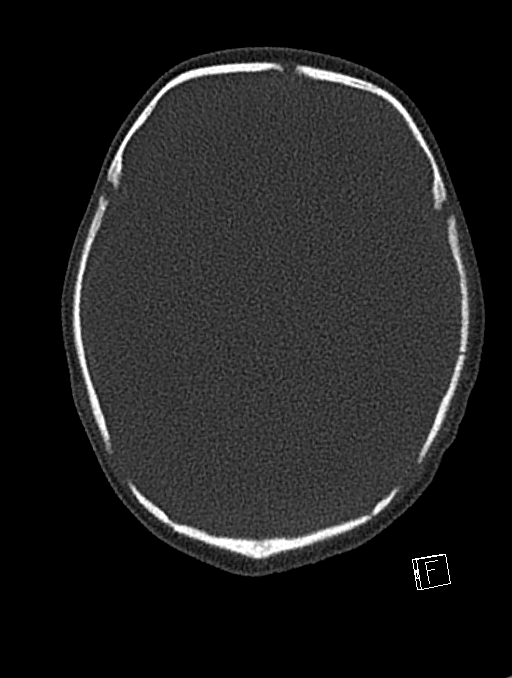 Bilateral subdural hemorrhage and parietal skull fracture (Radiopaedia 26058-26192 Axial bone window 80).png