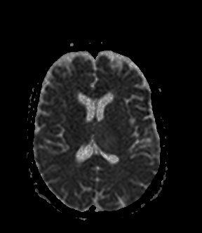 File:Bilateral thalamic glioma (Radiopaedia 65852-75009 Axial ADC 13).jpg