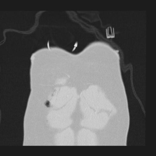 Bilateral traumatic renovascular injury (Radiopaedia 32051-32995 Coronal lung window 2).jpg