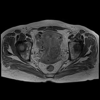Bilateral tubo-ovarian abscesses (Radiopaedia 58635-65829 Axial T1 C+ 32).jpg