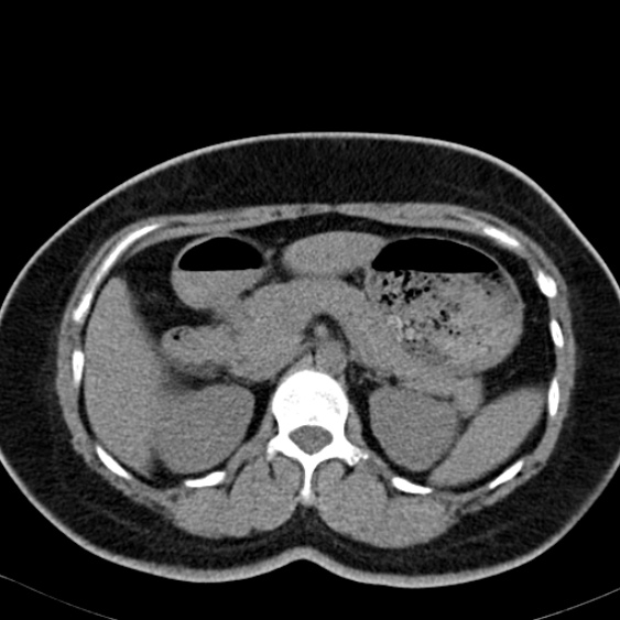 File:Bilateral ureteric stents (Radiopaedia 48795-53825 Axial non-contrast 17).jpg