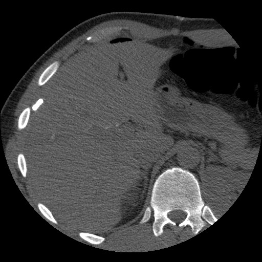 File:Bile leak from liver traumatic laceration (Radiopaedia 63463-72077 Axial Biliscopin 34).jpg