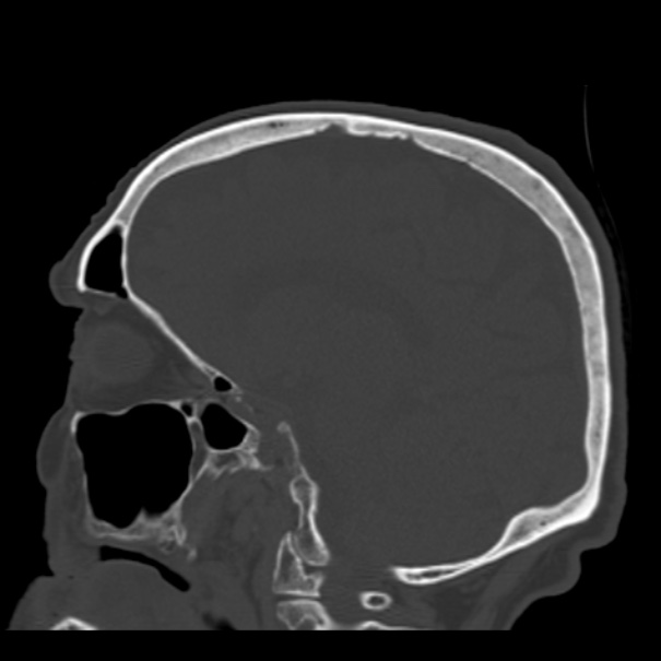 Biparietal osteodystrophy (Radiopaedia 46109-50463 Sagittal bone window 45).jpg
