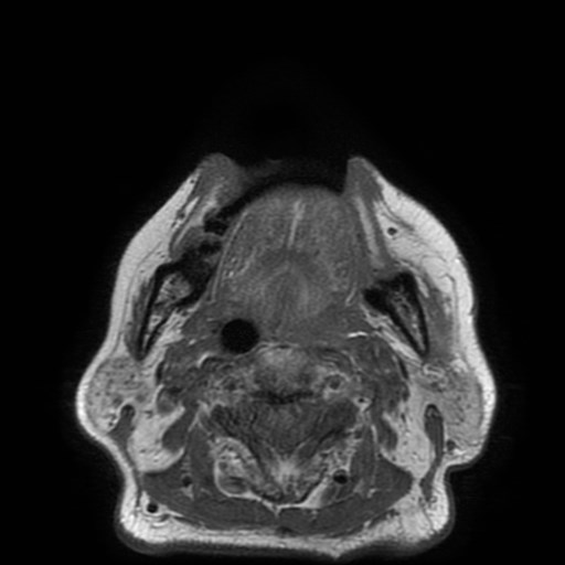 Bisphosphonate-related osteonecrosis of the maxilla (Radiopaedia 51367-57101 Axial T1 12).jpg