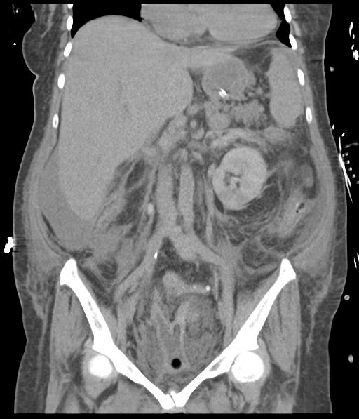 Bladder rupture post renal biopsy (Radiopaedia 30863-31572 Coronal non-contrast 31).jpg