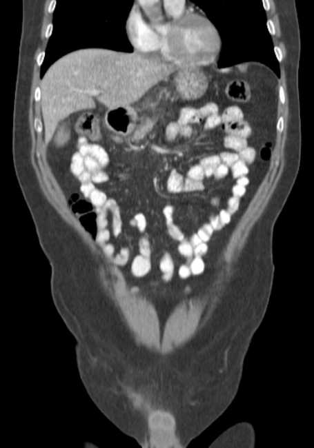 Bleeding duodenal ulcer and adenomyomatosis of gallbladder (Radiopaedia 61834-69861 B 61).jpg