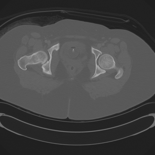 Blood in uterovesical and rectovesical pouch in trauma patient (Radiopaedia 34090-35340 Axial bone window 71).png