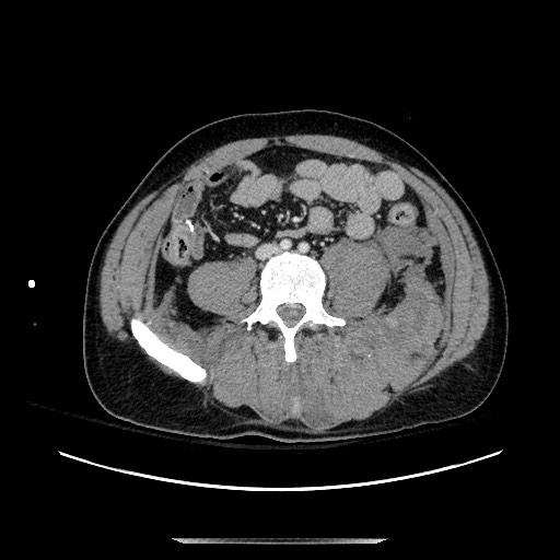 Blunt abdominal trauma with solid organ and musculoskelatal injury with active extravasation (Radiopaedia 68364-77895 A 96).jpg