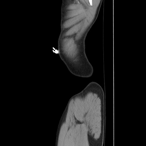 File:Blunt abdominal trauma with solid organ and musculoskelatal injury with active extravasation (Radiopaedia 68364-77895 C 16).jpg