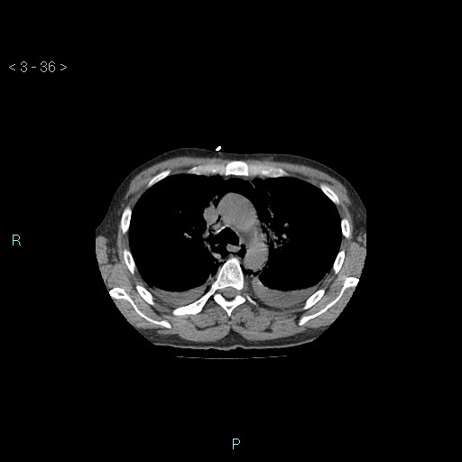 File:Boerhaave syndrome (Radiopaedia 27683-27897 Axial non-contrast 36).jpg