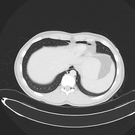 File:Boerhaave syndrome with mediastinal, axillary, neck and epidural free gas (Radiopaedia 41297-44115 Axial lung window 73).jpg