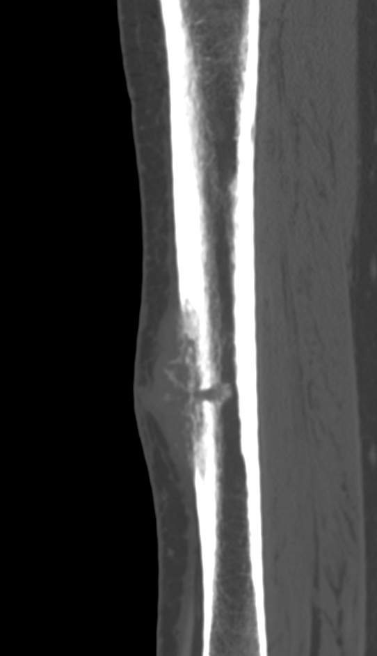 Bone metastasis - tibia (Radiopaedia 57665-64609 Sagittal bone window 88).jpg