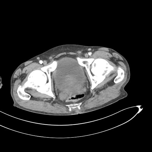 Bone metastasis from squamous cell carcinoma (Radiopaedia 30133-30730 B 75).jpg
