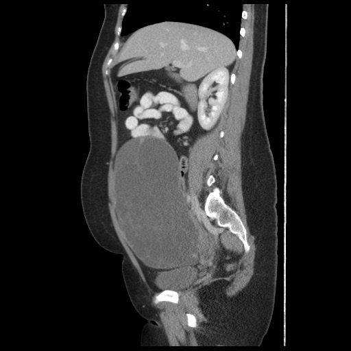 File:Borderline mucinous tumor (ovary) (Radiopaedia 78228-90808 B 27).jpg