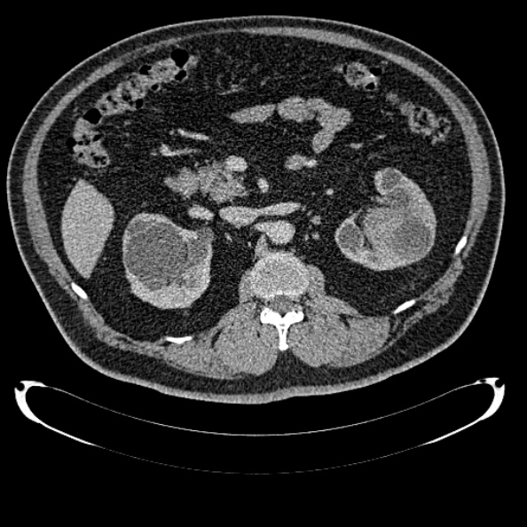 Bosniak renal cyst - type IV (Radiopaedia 24244-24518 C 135).jpg