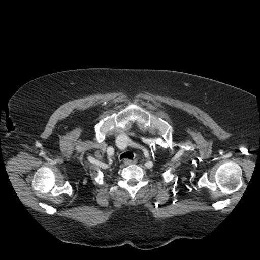 Bovine aortic arch - right internal mammary vein drains into the superior vena cava (Radiopaedia 63296-71875 A 17).jpg