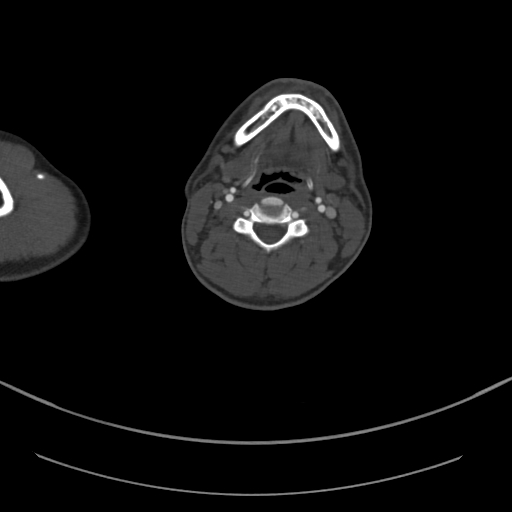 Brachiocephalic trunk pseudoaneurysm (Radiopaedia 70978-81191 Axial bone window 15).jpg