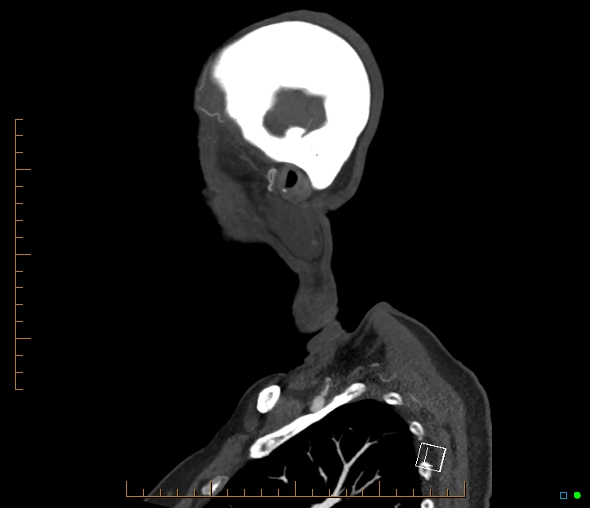 Brachiocephalic trunk stenosis (Radiopaedia 87242-103519 C 4).jpg