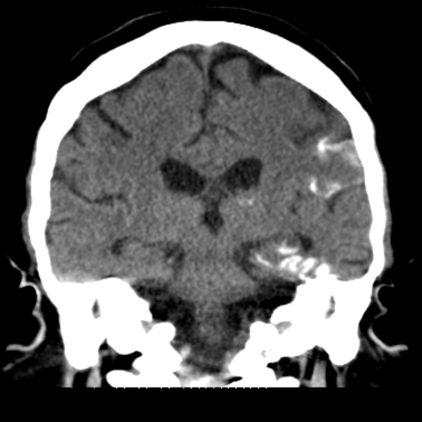 Brain cortical laminar necrosis (Radiopaedia 25822-25971 C 33).jpg